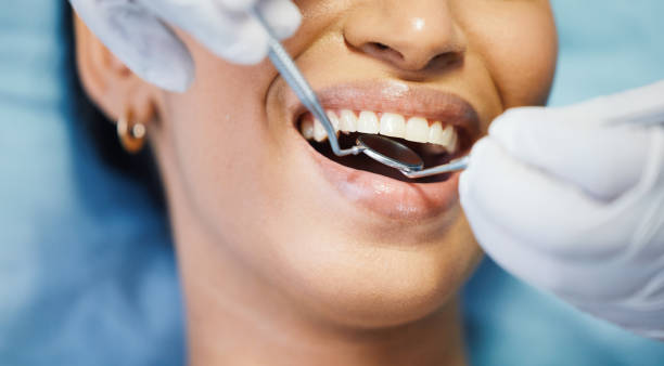 Best Broken or Chipped Tooth Repair in South Beach, FL